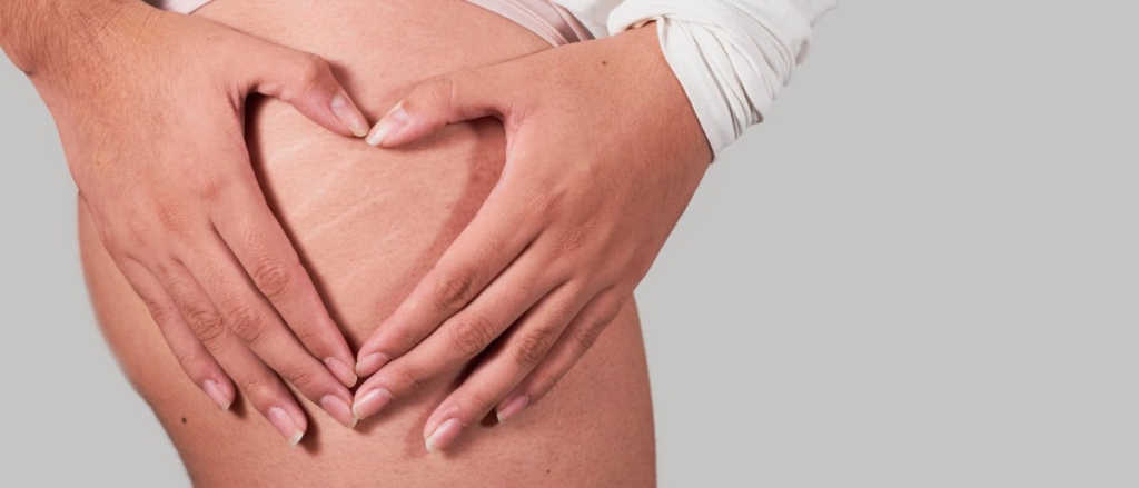 Estrías en el glúteo ¿qué las causa y cómo eliminarlas