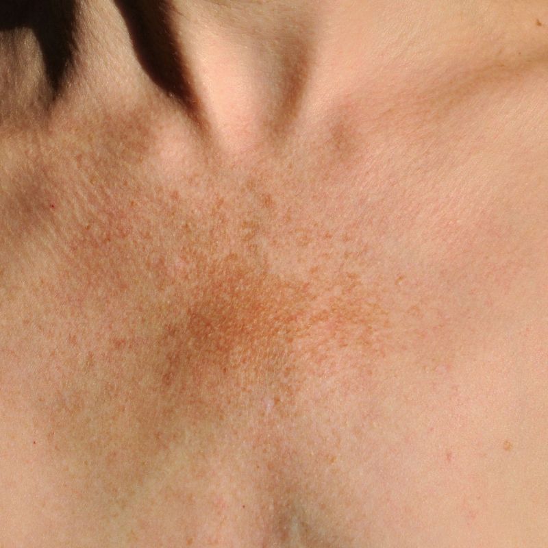 Melasma en el escote