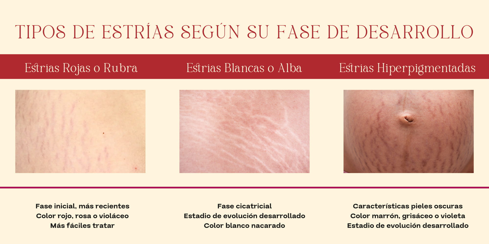 Tipos de estr&iacute;as en la piel