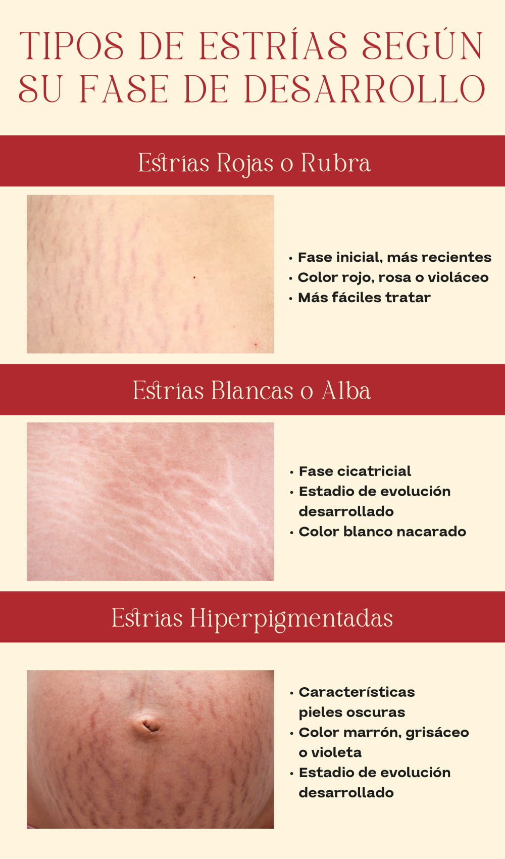 Tipos de estr&iacute;as en la piel
